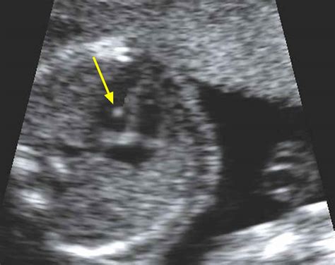 echogenic intracardiac focus down syndrome.